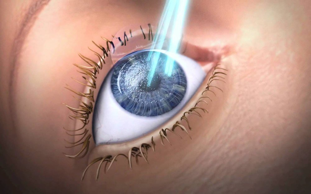 jenis sinar laser eximer untuk bedah lasik